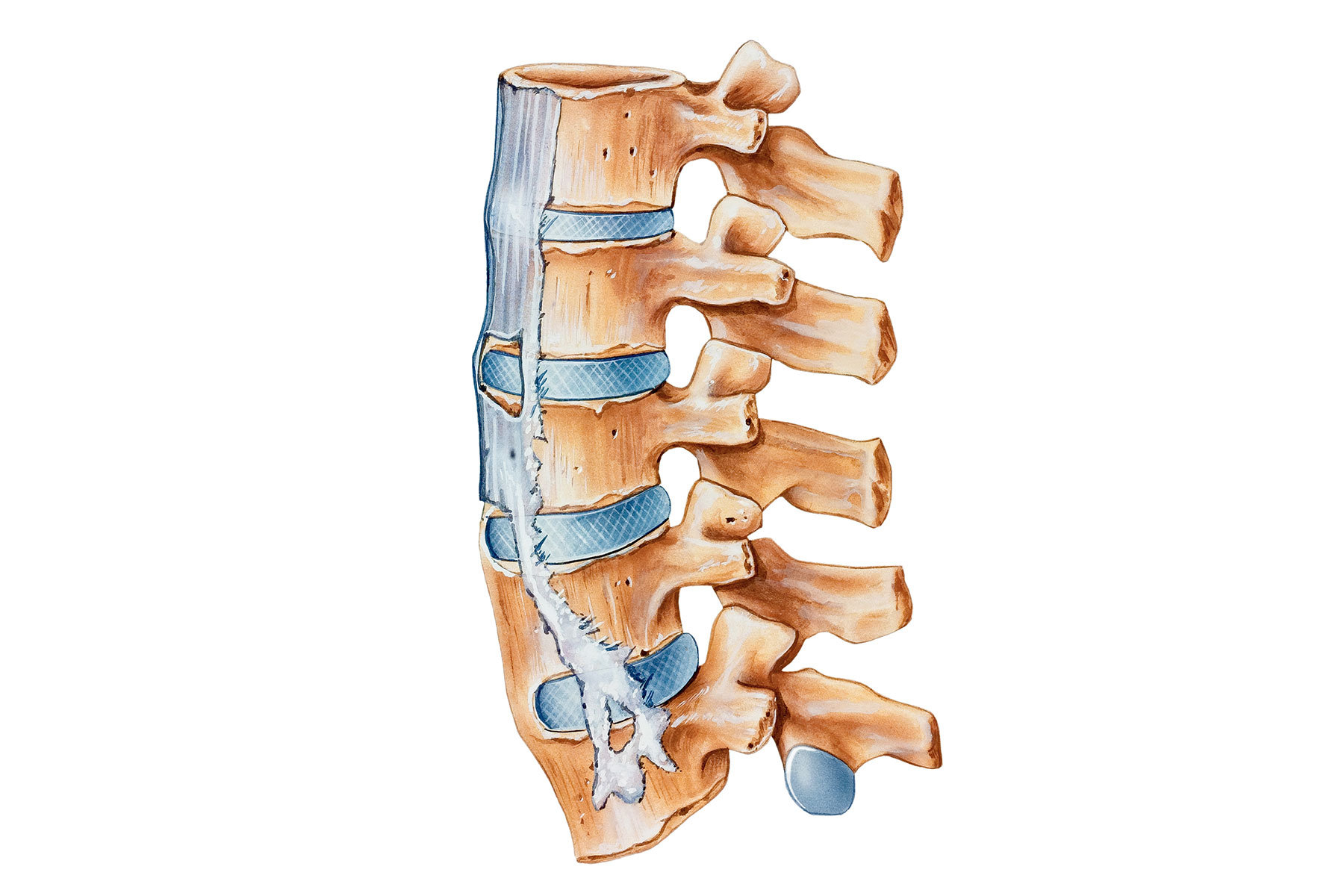 Co je ankylozující spondylitida (Bechtěrevova choroba)?